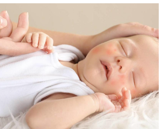 أسباب الحساسية عند الطفل الرضيع