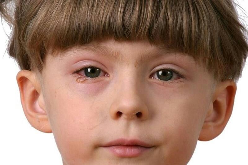 كيف تتعاملي مع احمرار العين عند طفلك؟