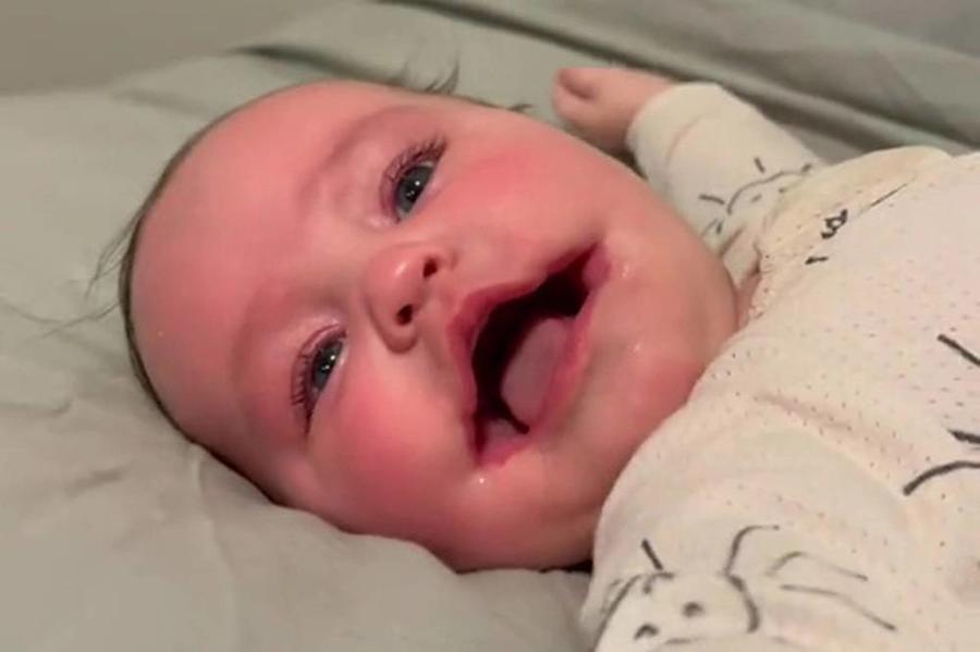 حالة نادرة.. ولادة طفلة في أستراليا مصابة بـالابتسامة الدائمة_صور
