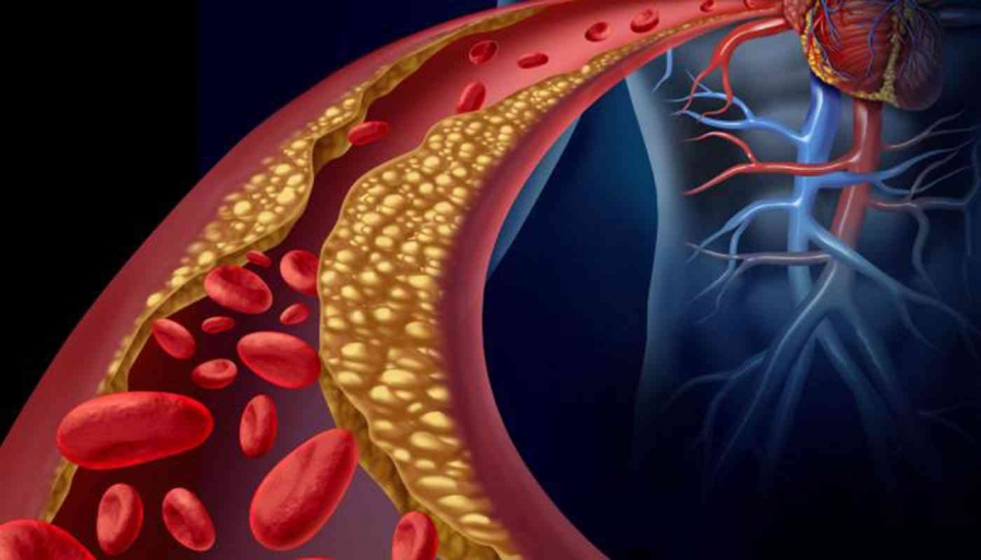 ارتفاع الكولسترول في الدم يزيد من خطر الإصابة بأزمة قلبية