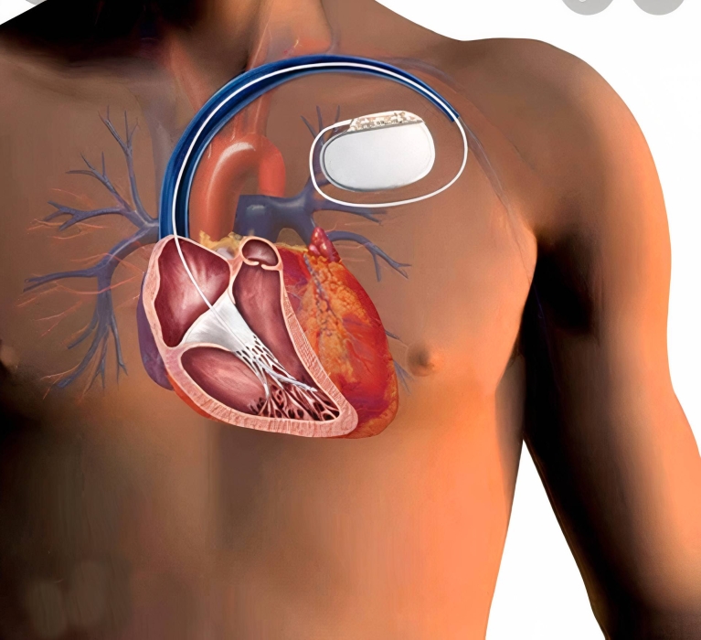 الهواتف الذكية خطر على أجهزة تنظيم ضربات القلب