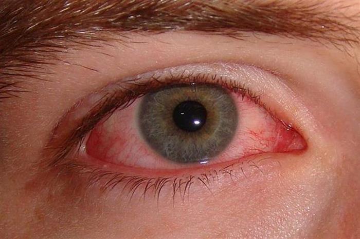  طبيب عيون   يوضح ما الذي يحفز التهاب الملتحمة  تفاصيل