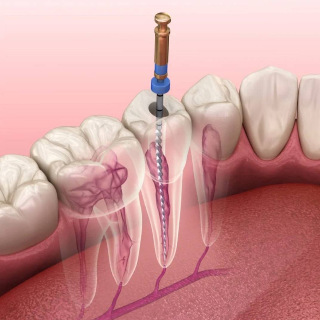 ماهو عصب الأسنان ؟